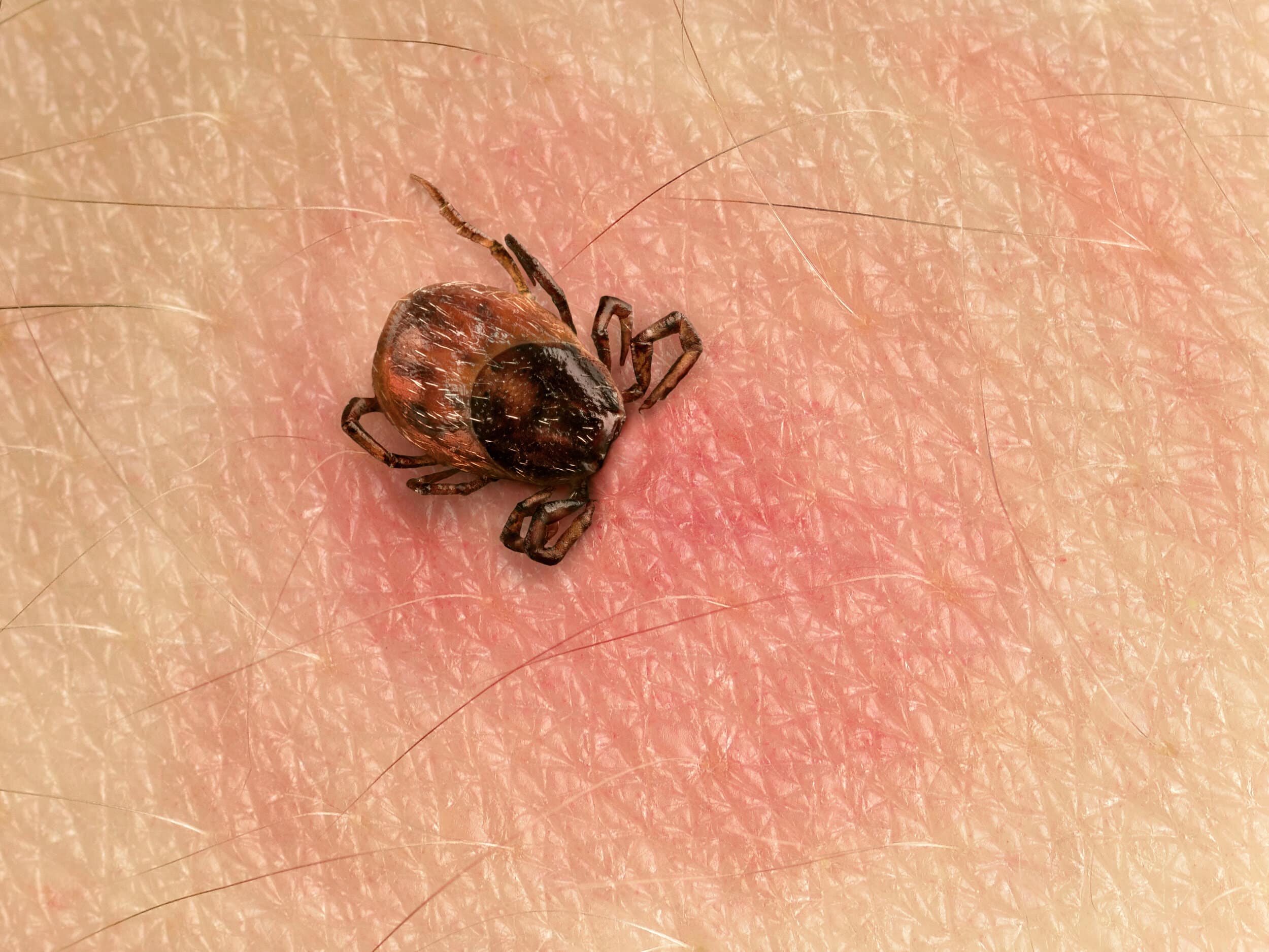 The Three Stages Of Lyme Disease